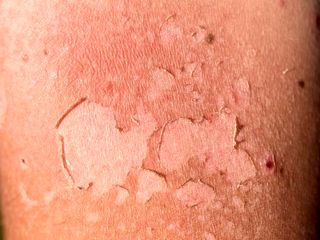  8 نشانه ای که می گوید شما به بیماری‌ های پوستی دچار شده اید